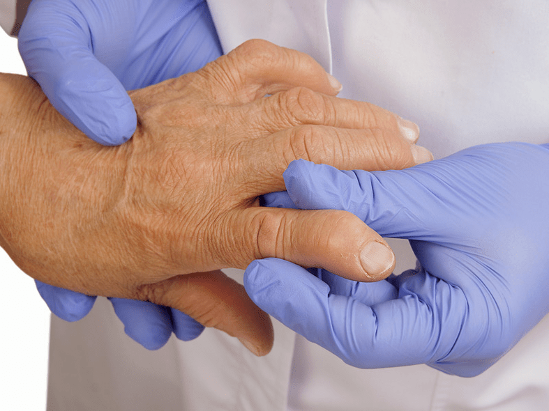 Dokter ënnersicht Hand fir Péng an Fanger Gelenker