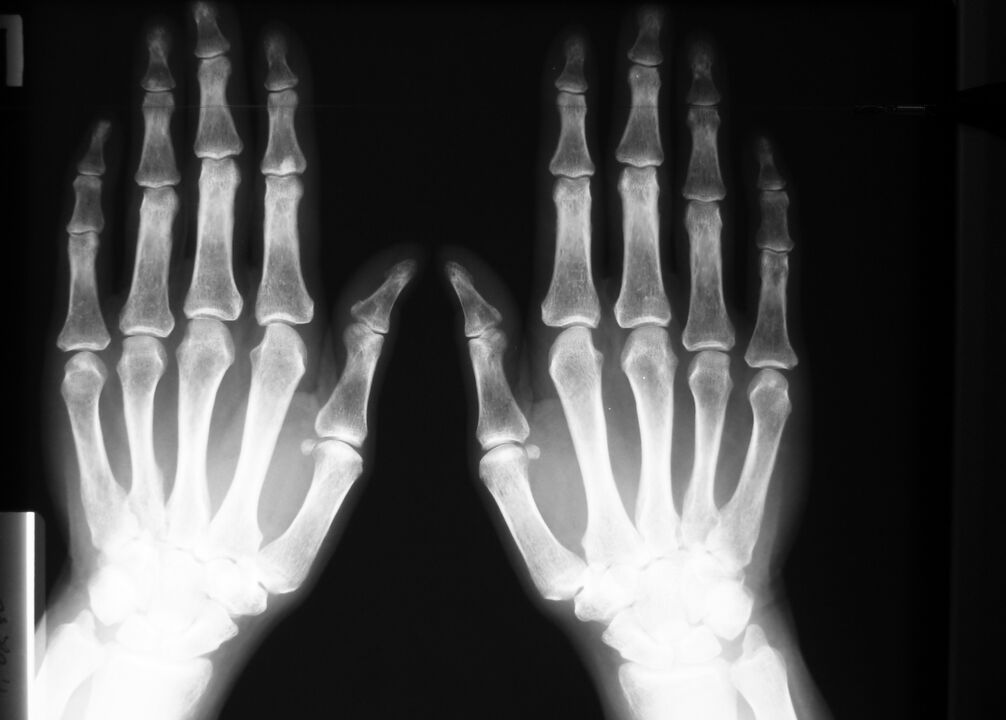 Röntgen fir Péng an de Gelenker vun de Fanger ze diagnostizéieren